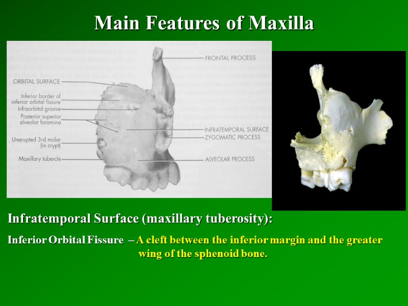 Main Features of Maxilla   Infratemporal Surface (maxillary tuberosity): Inferior Orbital Fissure 